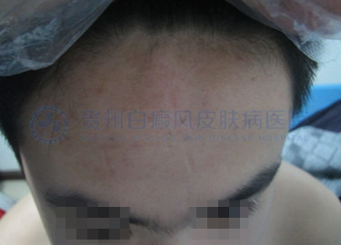 青少年头部局限性白癜风2个月