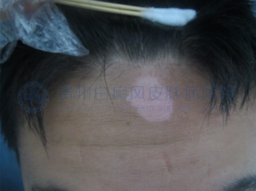 青少年头部局限性白癜风2个月