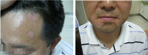 男性1年白癜风在我院3个月康复