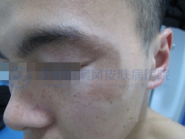 青少年脸部白斑三个月