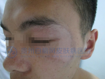 青少年脸部白斑三个月