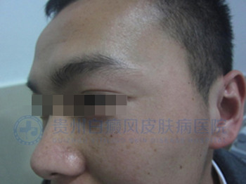 青少年脸部白斑三个月