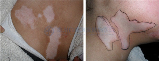 青少年胸部患白癜风2年,在我院4个月治好