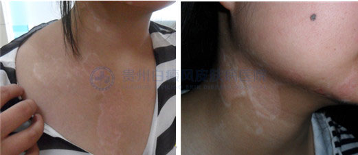青少年胸部患白癜风2年,在我院4个月治好