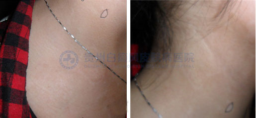 青少年胸部患白癜风2年,在我院4个月治好