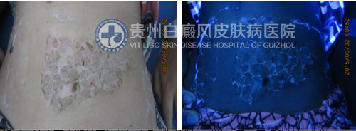 腹部白斑四年在我院三个月治愈