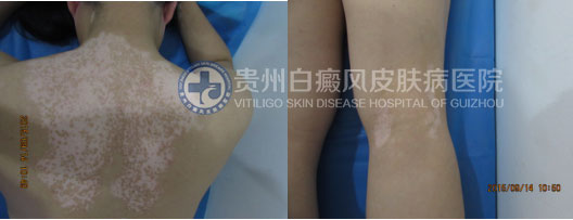 坚持不懈的治疗,白斑总有痊愈的一天