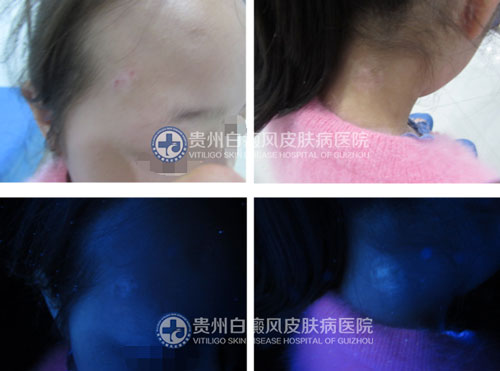 李女士 面部、颈部白斑三年