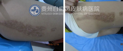 白斑消失了 女孩重获自信笑容
