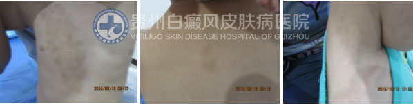 告别白斑,还孩子一个“无瑕”的童年