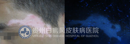 高考“前夕”遭白斑突袭,一朝康复送锦旗致谢