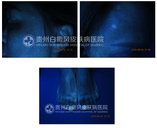 选择贵州白癜风皮肤病医院,和“白斑”说拜拜