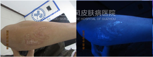 20年白斑终祛除,喜不自禁