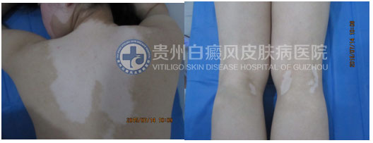 坚持不懈的治疗,白斑总有痊愈的一天