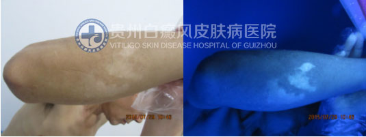 20年白斑终祛除,喜不自禁