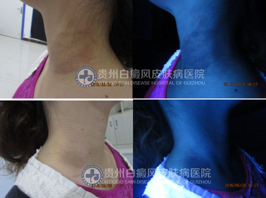 “卸”去白斑,昂首挺胸再展风采