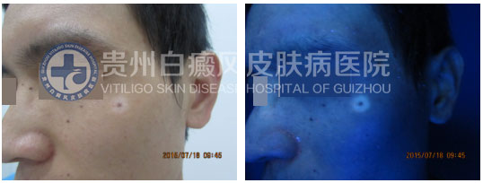 男性晕痣白斑,在我院轻松治愈