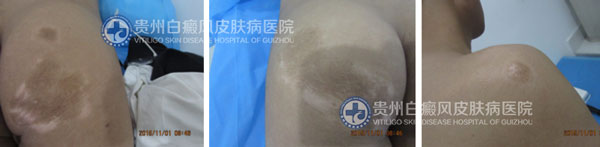 张某 男 肩部、臀部白斑1年半