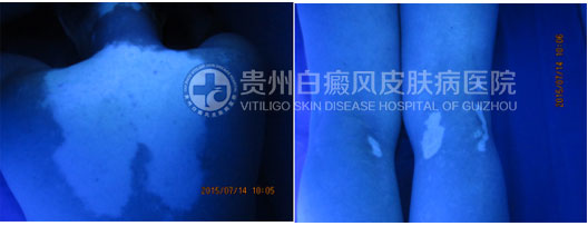 坚持不懈的治疗,白斑总有痊愈的一天