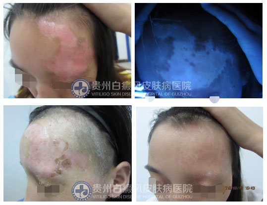 拯救“白眉女孩”行动,让青春不留遗憾