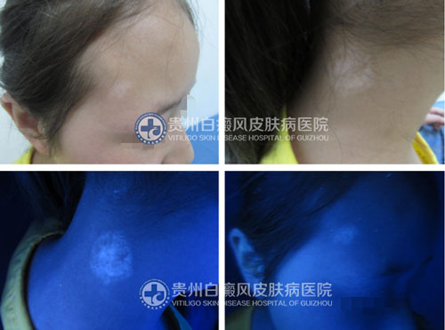 李女士 面部、颈部白斑三年