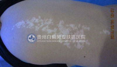 白斑消失了 女孩重获自信笑容