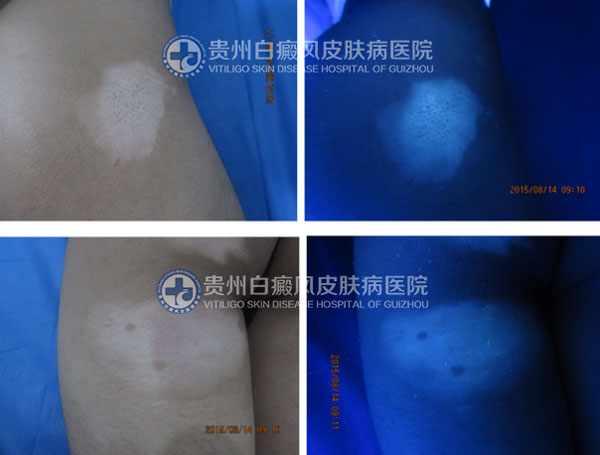 张某 男 肩部、臀部白斑1年半