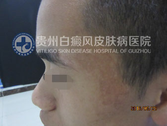 高考“前夕”遭白斑突袭,一朝康复送锦旗致谢