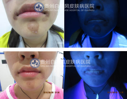 “痤疮”引发白斑告急,贵州白癜风医院助其恢复美丽容颜