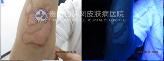 20年白斑终祛除,喜不自禁