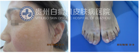选择贵州白癜风皮肤病医院,和“白斑”说拜拜