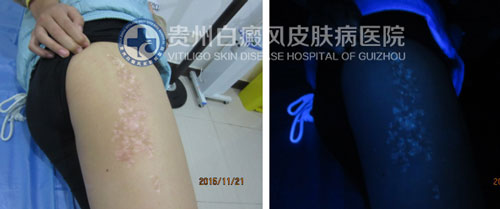 白斑消失了 女孩重获自信笑容