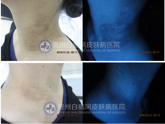 “卸”去白斑,昂首挺胸再展风采