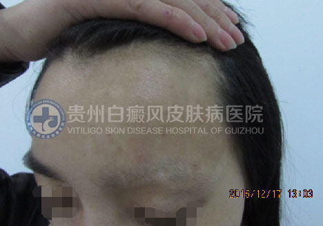 拯救“白眉女孩”行动,让青春不留遗憾