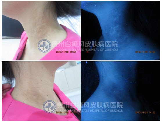 “卸”去白斑,昂首挺胸再展风采