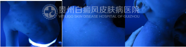 告别白斑,还孩子一个“无瑕”的童年