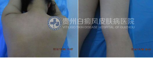 坚持不懈的治疗,白斑总有痊愈的一天