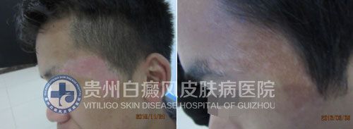 高考“前夕”遭白斑突袭,一朝康复送锦旗致谢