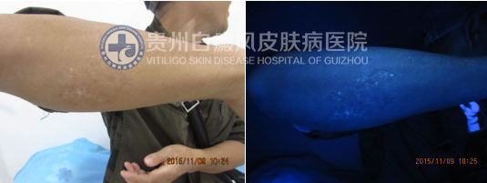 20年白斑终祛除,喜不自禁