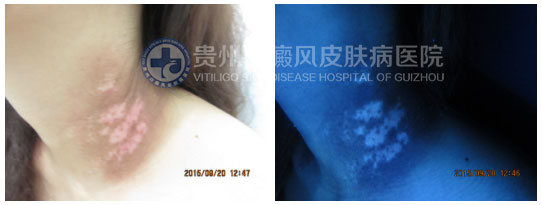 “卸”去白斑,昂首挺胸再展风采