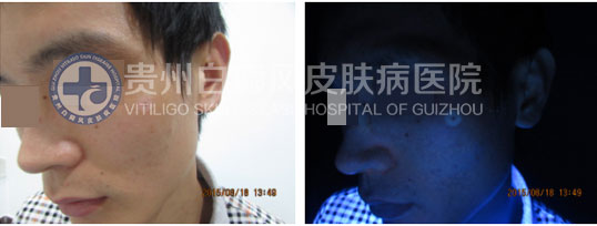 男性晕痣白斑,在我院轻松治愈