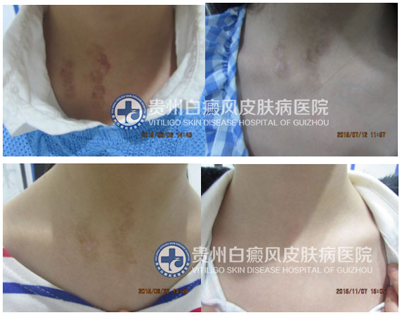 解下“白”围脖,迎接新生活