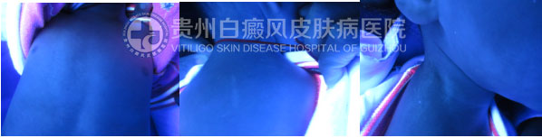 告别白斑,还孩子一个“无瑕”的童年