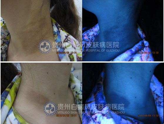 “卸”去白斑,昂首挺胸再展风采