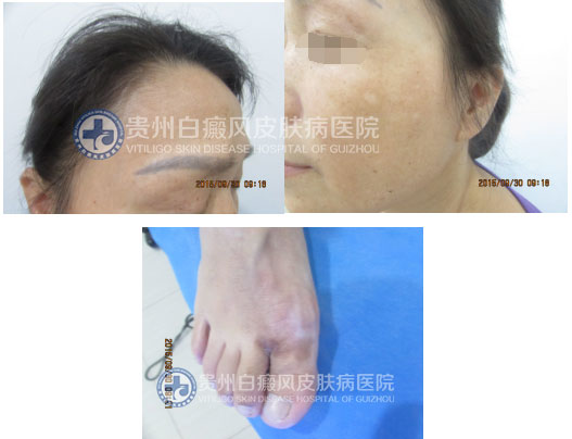 选择贵州白癜风皮肤病医院,和“白斑”说拜拜