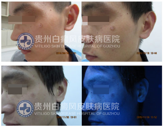 男性晕痣白斑,在我院轻松治愈