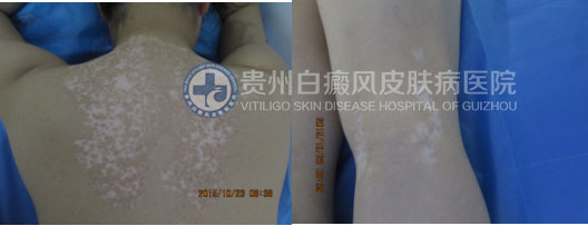 坚持不懈的治疗,白斑总有痊愈的一天