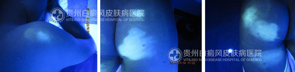 张某 男 肩部、臀部白斑1年半