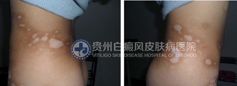 使用了这一技术,九岁女孩90天告别白癜风