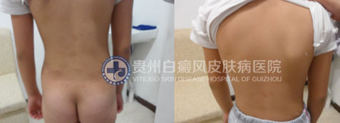 使用了这一技术,九岁女孩90天告别白癜风